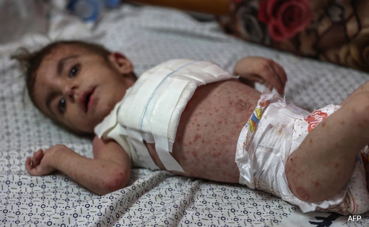 Harmful Pores and skin Illnesses Spreading Amongst Malnourished Youngsters In Gaza